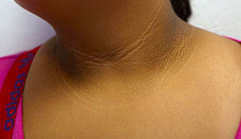 Acanthosis Nigricans